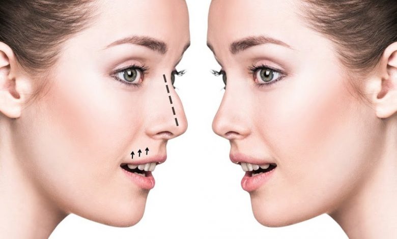 open and closed rhinoplasty