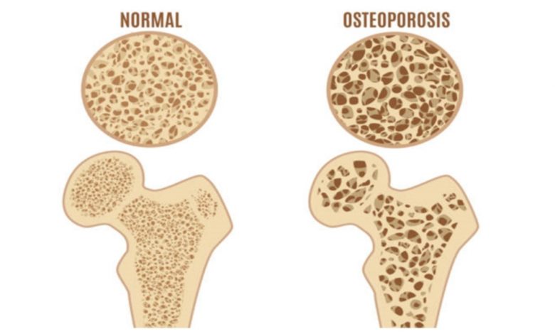 osteoporosis